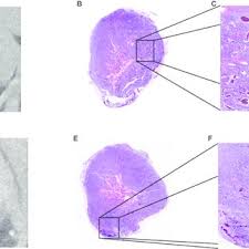 The doctor will examine your skin for signs of jaundice and will feel the abdomen for lumps or a change in the shape or size of the liver. Pdf Micro Ct Imaging Of Breast Tumors In Rodents Using A Liposomal Nanoparticle Contrast Agent