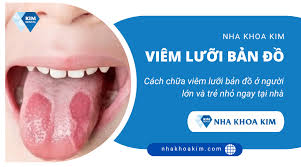 Cách chữa viêm lưỡi bản đồ ở người lớn và trẻ nhỏ ngay tại nhà