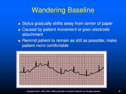 In this paper we proposed a technique to remove baseline wander using kaiser windowing filter and wavelet transform, among which wavelet is most powerful and effective tool for analyzing transient signal. Principles Of Electrocardiography Ppt Download