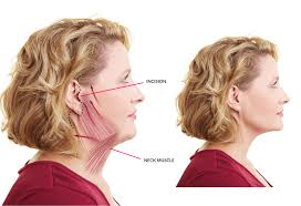 Face Lift Nz Facelift Surgery Cost Tauranga Rotorua