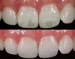 Icon Treatment White Spot Correction Advanced Services