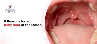 Image result for Mouth ulcers symptoms roof of the mouth