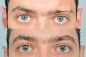 Although eyebrow trends may come and go. Eyebrow Transplantation Is A Surgical Procedure Intended To Permanently Restore And Or Customize The Appearance O Eyebrow Makeup Eyebrows Fue Hair Transplant