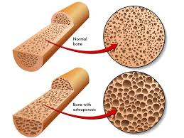 Stress fractures are commonly found in the spine, vertebrae, leg bones, feet, and pelvis. Osteoporosis Food Quiz