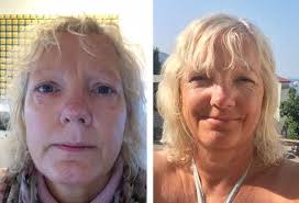 Here Are 35 Eye Opening Photos Taken Before And After People Stopped Drinking In 2020 Stop Drinking People Photo