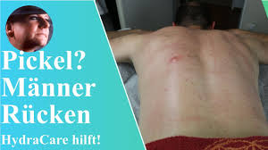Pickel Jucken Manner Rucken Pickel Ruecken Manner Rucken Youtube