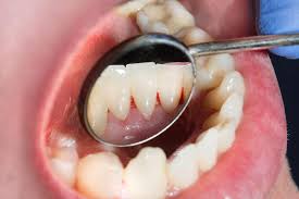 Image result for gums cancer symptoms