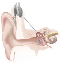 A cochlear implant (ci) is a surgically implanted neuroprosthetic device to provide a person with moderate to profound sensorineural hearing loss a modified sense of sound. Prostheses
