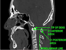 Posterior margin of the spinal canal. Epos C 2397