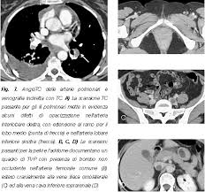 La embolia pulmonar suele ser causada por coágulos sanguíneos que viajan a los pulmones desde las piernas. La Dignostica Per Immagini Nella Pratica Clinica Tc Multidetettore