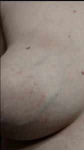 Usual features of inflammation are skin thickening, redness and warmt. Rash On Breast Picture Included Breastfeeding Forums What To Expect
