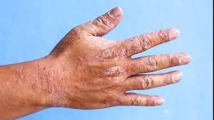 Hand sanitizers labeled as containing the term alcohol, used by itself, are expected to contain ethanol. Palm Rash Causes Pictures And Treatments