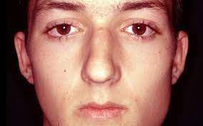 Mumps Symptome Ursachen Mumps Masern Roteln Impfung Onmeda De