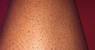 Woman Ingrown Hair On Legs
