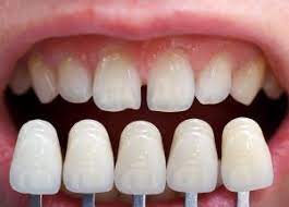Veneers Porcelain False Teeth In Salem Oregon