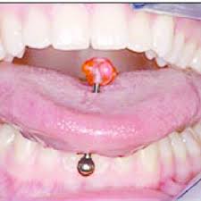 Pdf Complications Of Tongue Piercing A Review Of The Literature And Three Case Reports