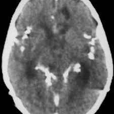 Diffuse Calcifications Of The Basal Cisterns Leptomeningeal Download Scientific Diagram