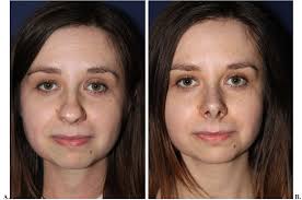 Massage each part of your nose, starting from the bridge, to the tip, and then finally the sides. How To Slim A Bulbous Nose With Makeup Saubhaya Makeup