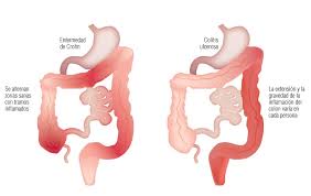 If you have been diagnosed with crohn's disease or are looking for. Crohn S Disease Ulcerative Colitis And Dao Deficiency Ad Dietistas