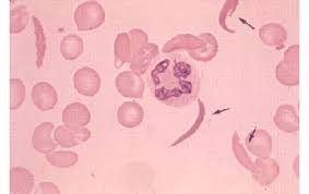Sickle Cell Disease And Thalassemia Hematology Org