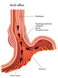 Reduce or eliminate foods that are spicy. Seven Easy Ways To Resolve Acid Reflux Naturally Lasting Change Health