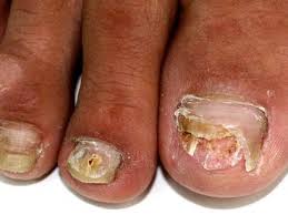 Image result for Onycholysis feet
