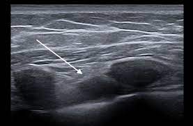 Patients presented with the supraclavicular lymphadenopathy in the medicine department have a strong suspicion of serious illness like tuberculosis, sarcoidosis, toxoplasmosis and malignancy of lymphnode, blood, lung, upper git, breast, ovary, testes, and other sites of body. Internal Mammary Lymph Node Metastases Radiology Case Radiopaedia Org