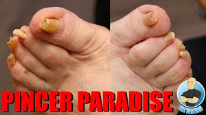 super curved pincer toenails