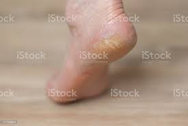 Clavus Und Risse An Der Ferse Des Fusses Stockfoto Und Mehr Bilder Von Abhangigkeit Istock