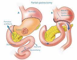 In countries where screening for stomach cancer is not routine, such as the united states, most stomach cancers aren't found until they've grown fairly large or have spread outside the stomach. Stomach Cancer Treatment Surgery For Stomach Cancer Perth