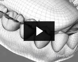 CEREC Dental Procedure in Bigfork, MT