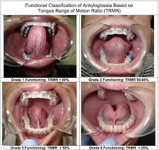 Tongue Tie Classification Some Can Be Subtle But Affect The Health And Develipment Tongue Tie Sleep Apnea Oral Surgeon