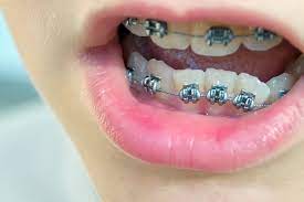 Das gesicht wirkt hässlich und entstellt. Feste Spange Lose Klammer Welche Behandlungsformen Gibt Es Verbraucherzentrale De