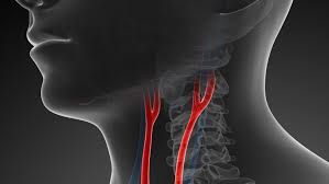 Note how the left common carotid and subclavian arteries arise directly from the arch of aorta. Carotid Arteries
