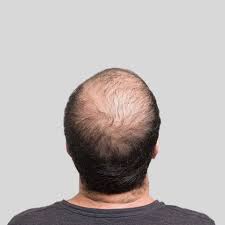 Also, hair growth varies depending on body. Male Pattern Baldness How To Fight Hair Loss