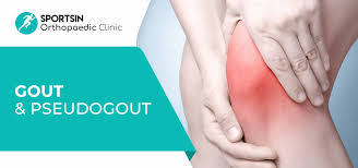 Image result for gout symptoms knee