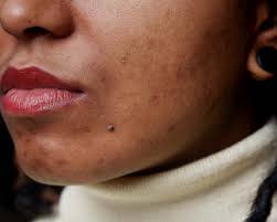 Videos you watch may be added to the tv's watch history and influence tv recommendations. Isotretinoin Accutane How It Works Side Effects Risks