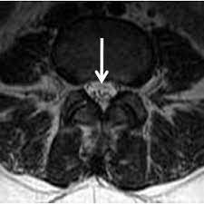Guillain barré syndrome (a neurological disorder in which the body's immune system damages nerve cells, causing muscle weakness and sometimes paralysis) has occurred in some people who have. Pdf Spinal Mri Findings Of Guillain Barre Syndrome
