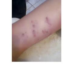 Bedbugs leave a small bite mark on the skin that is red and itchy or in rare cases causes a serious allergic reaction. Leg Of Child Aged 9 Years Shows Multiple Fang Marks Download Scientific Diagram