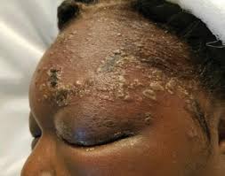 Image result for herpes zoster