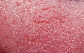 How To Get Rid Of Swollen Taste Buds Ehow Inflamed Taste Buds Bumps On Tongue Tongue Taste Buds