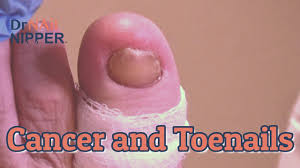 Spot that looks like a new mole, freckle, or age spot, but it looks different from the others on your melanoma can develop under a fingernail or toenail, looking like a brown line as shown here. Numb Toes To Trim Toenails With Cancer Survivor And Dr Nail Nipper 2021 Youtube