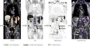 If prostate cancer is suspected, a physical examination and the following tests may be used to decide if more diagnostic tests are needed it is important to know that structural changes to the bone, such arthritis or bone injuries like fractures, can also be interpreted as abnormal and need to be evaluated. Radionuclide And Hybrid Imaging Of Recurrent Prostate Cancer The Lancet Oncology