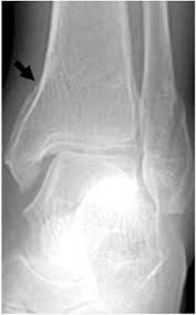 Learn the causes, symptoms & treatments for fibula injuries. Ankle Fractures Trauma Orthobullets
