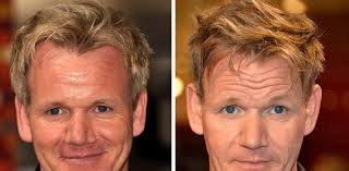 Personaggi famosi che si sono sottoposti al trapianto di capelli. Vip Archives Ricrescita Capelli