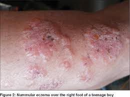 Image result for dermatitis contacta children