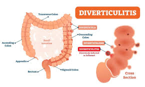 Image result for Diverticulitis