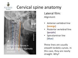 The use of intralaminar screws (ils) in spinal surgery has experienced a recent increase in popularity. Rah Med 4 Ortho Spinal Imaging