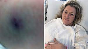 Which spider bites can be fatal? Mother Talks About Surviving Funnel Web Spider Bite Youtube