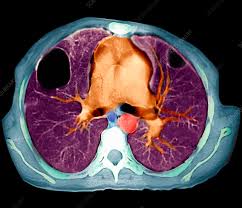 Image result for Lung Abscess
